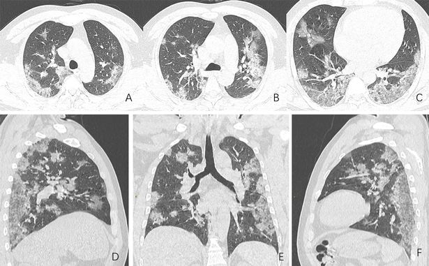 Patients' lungs appear like a layer of cloudy white glass, or sometimes entirely white due to having too much fluid instead of air.