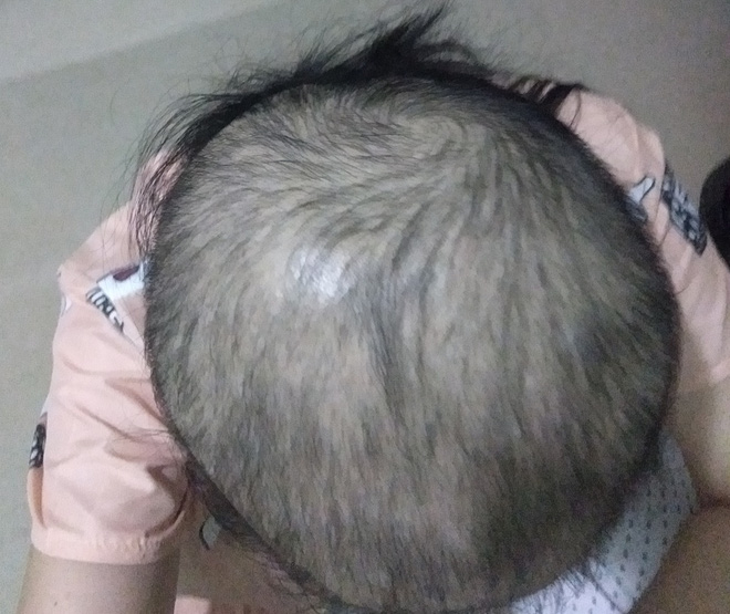 Image of a bald head due to hair pulling.