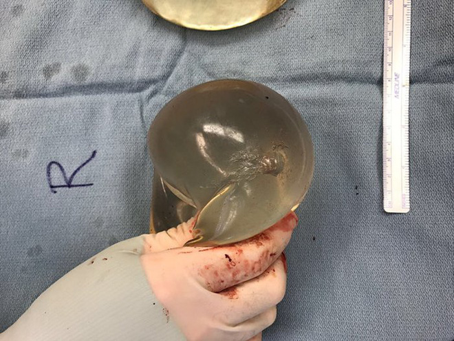 The silicone implant damaged by a bullet.