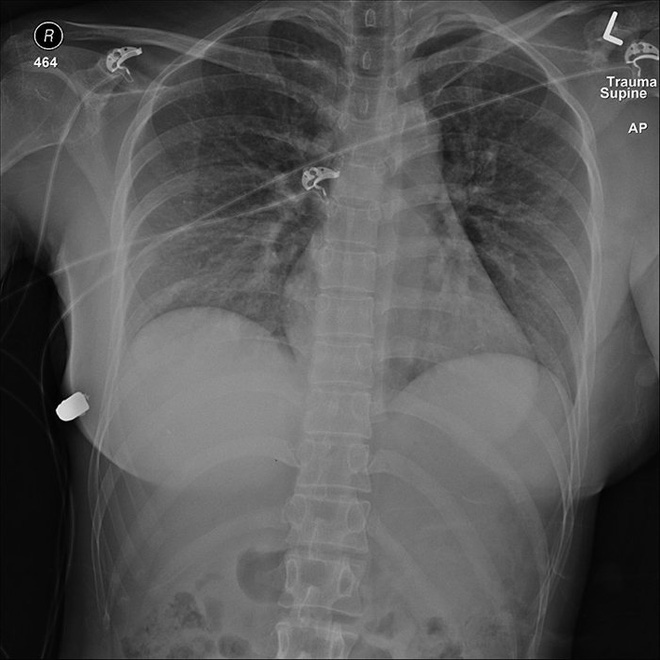 X-ray images show the bullet inside the body.