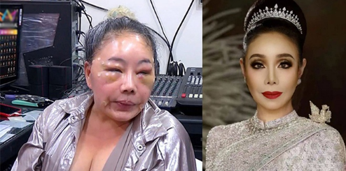 The artist's swollen face was suspected to be due to abuse from her younger husband in 2018.