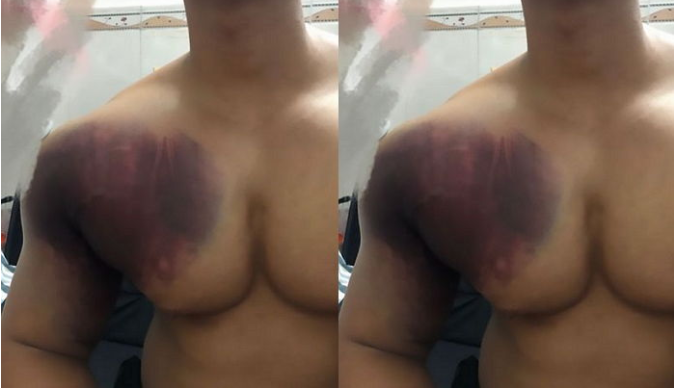 The condition of a man after being crushed by a 190kg weight