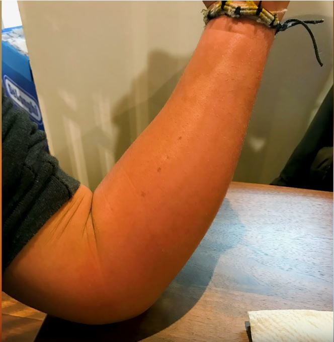 The wasp sting left his entire arm bright red