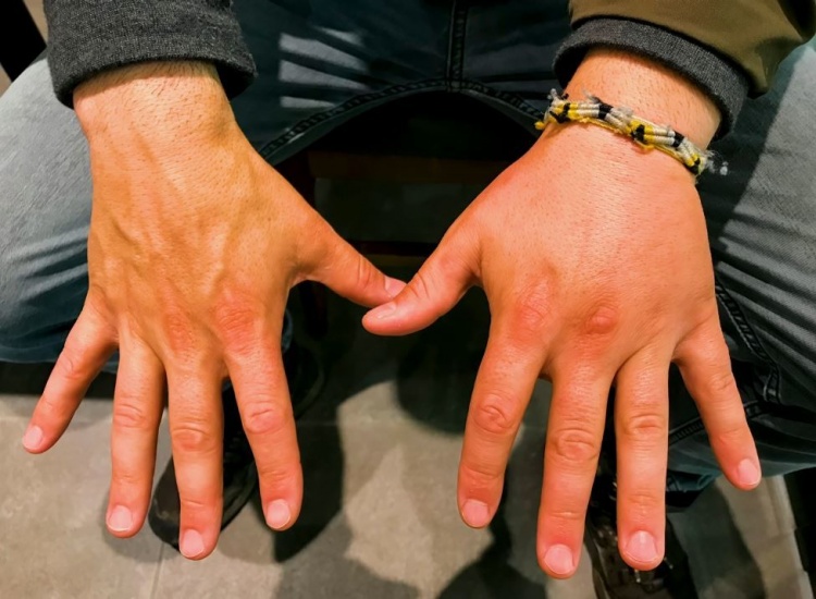 And even his fingers swelled up