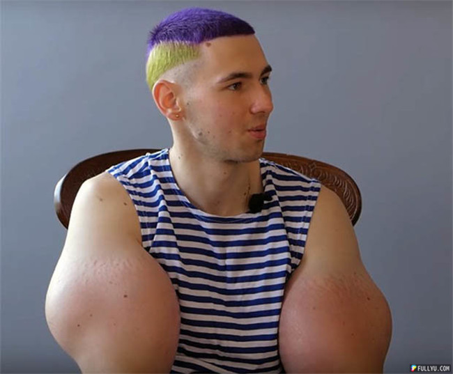 This has caused Kirill Tereshin to excessively abuse injection substances, leading to his muscles deforming like this