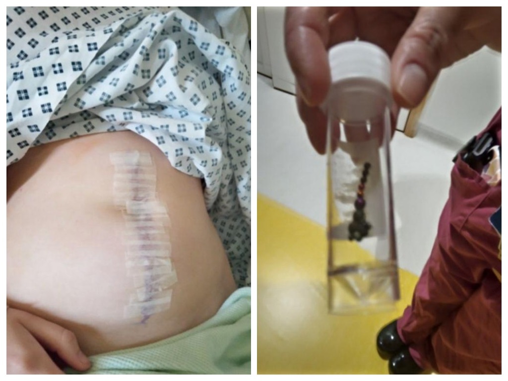 The boy had nearly 13cm of his intestine removed