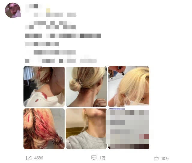 Xiao Hong shared a series of photos of her severe injuries