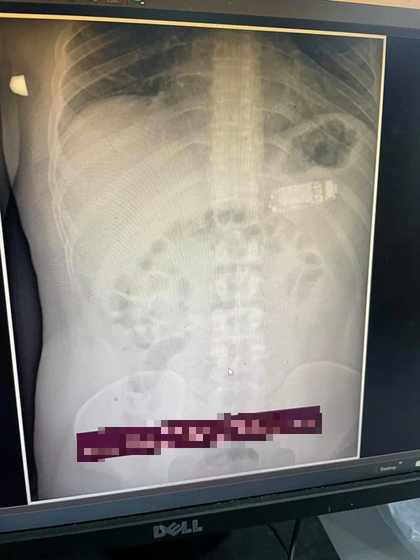 Endoscopy image of the gamer's stomach