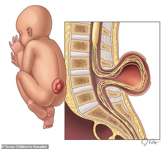 Spinal bifida can cause newborns to grow tails, but this is just a pseudo-tail.