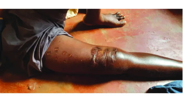 The horrific injuries caused by the crocodile on Chimedza