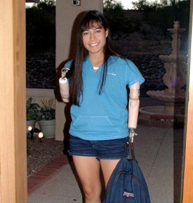 Jessica had 11 years attached to prosthetic arms before she decided to give them up.