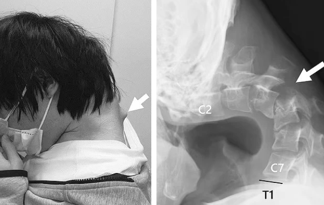 The Scary Images of Unscientific Gaming: A Warning for Gamers 2 This case was published in JOS Case Reports with the consent of the patient and family.