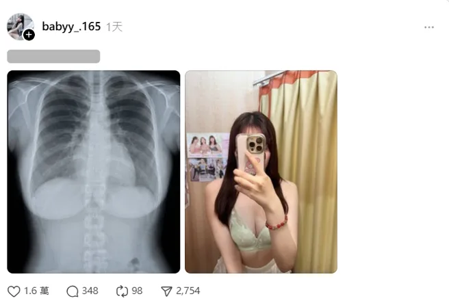 Streamer Shares X-ray of Her Breasts, Attracts Over 1.25 Million Views, Sparks Controversy 2 photo 1757471914935 1757471916624509444883 1757472086431 17574720867621722366151 1757476165175 1757476166239897037410
